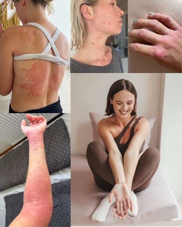 Mia's own skin: eczema and psoriasis across her back, face, hand and arm, alongside a recent photo with clear skin