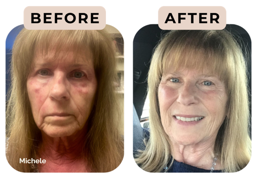 Before and after photos of Michele, showing facial redness and inflammation clearing