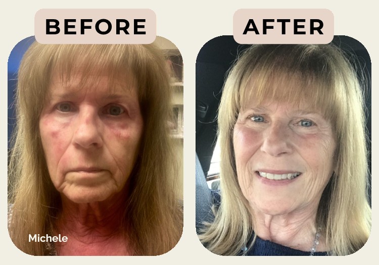 Michele before and after