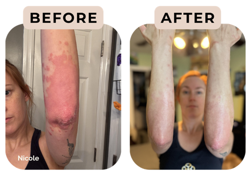 Before and after photos of Nicole, showing raised, inflamed patches on the arm clearing
